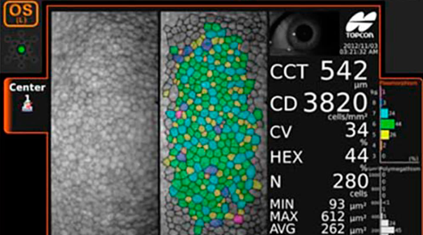 microscopia especular da córnea
