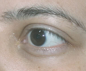Tratamento de Olhos Proeminentes
