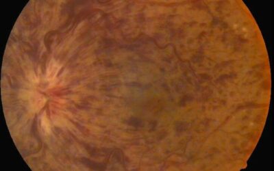 Oclusão venosa da retina parece ser algo complicado, mas não é!